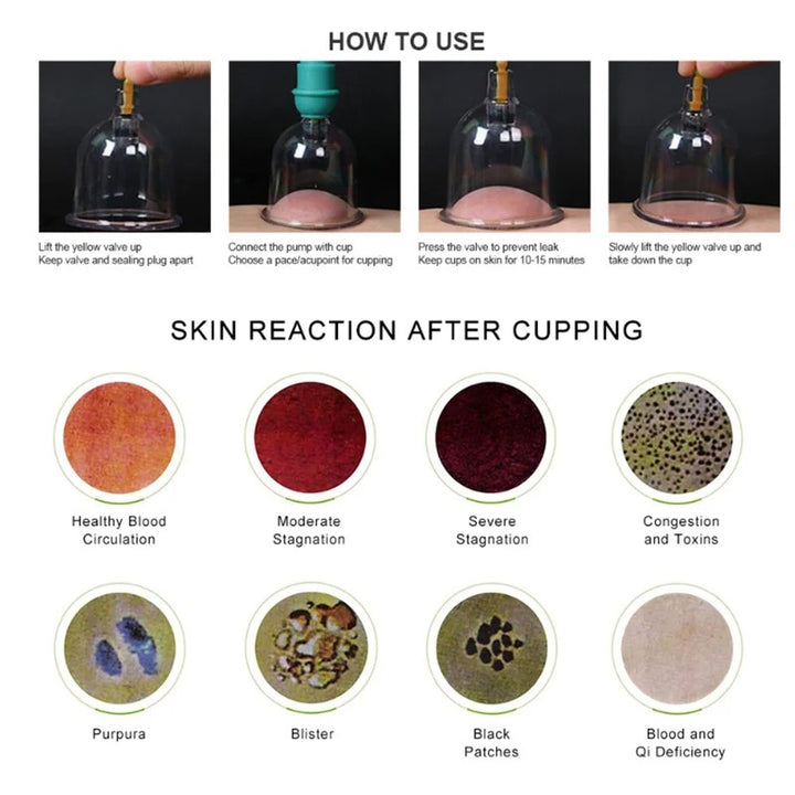 Premium Vacuum Cupping Therapy Set – 6, 12, or 24 Plastic Suction Cups for Massage, Relaxing Muscles, Pain Relief, and Well-Being, Safe Alternative to Traditional Cupping, Durable Quality - StrengthXPhysiotherapy