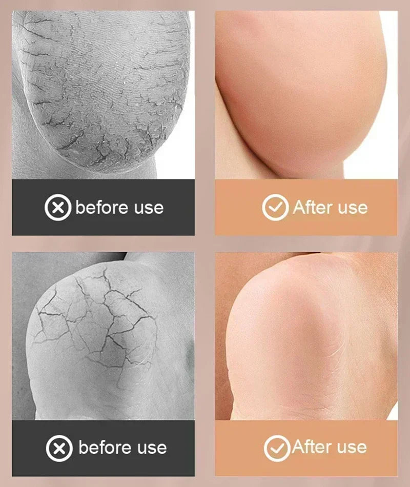 High-Quality Silicone Anti-Cracking Moisturizing Heel Socks - Relieve Heel Pain, Prevent Dry Skin Cracking, & Hydrating Spa 